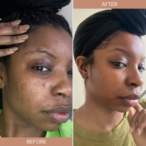 Complexion Bars for Hyperpigmentation & Dark Spots