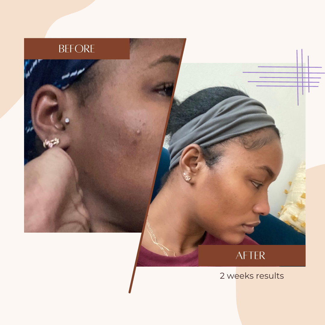 Complexion Bars for Hyperpigmentation & Dark Spots